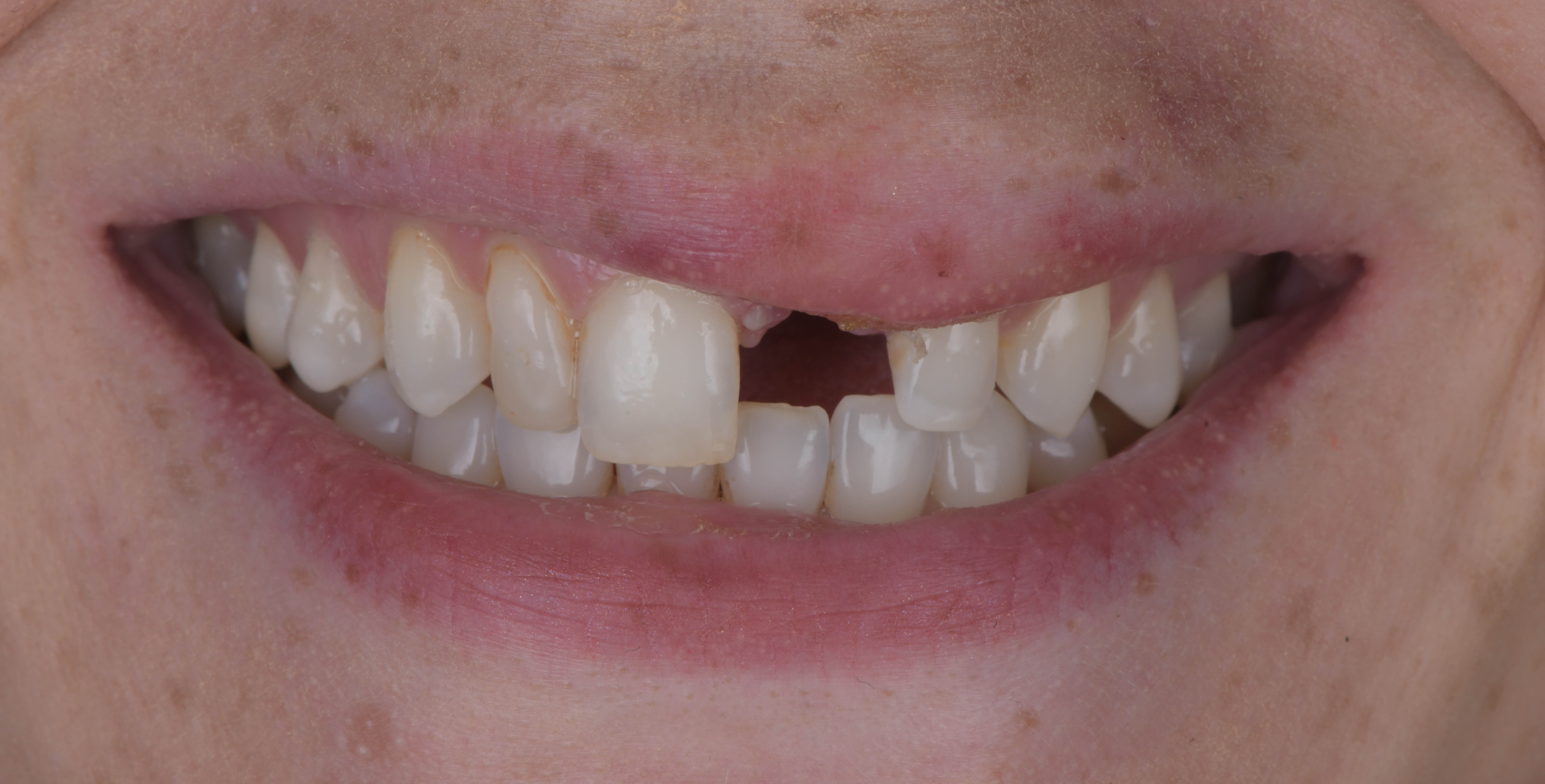 Before single dental implant with gum and bone graft, Marylebone Smile Clinic