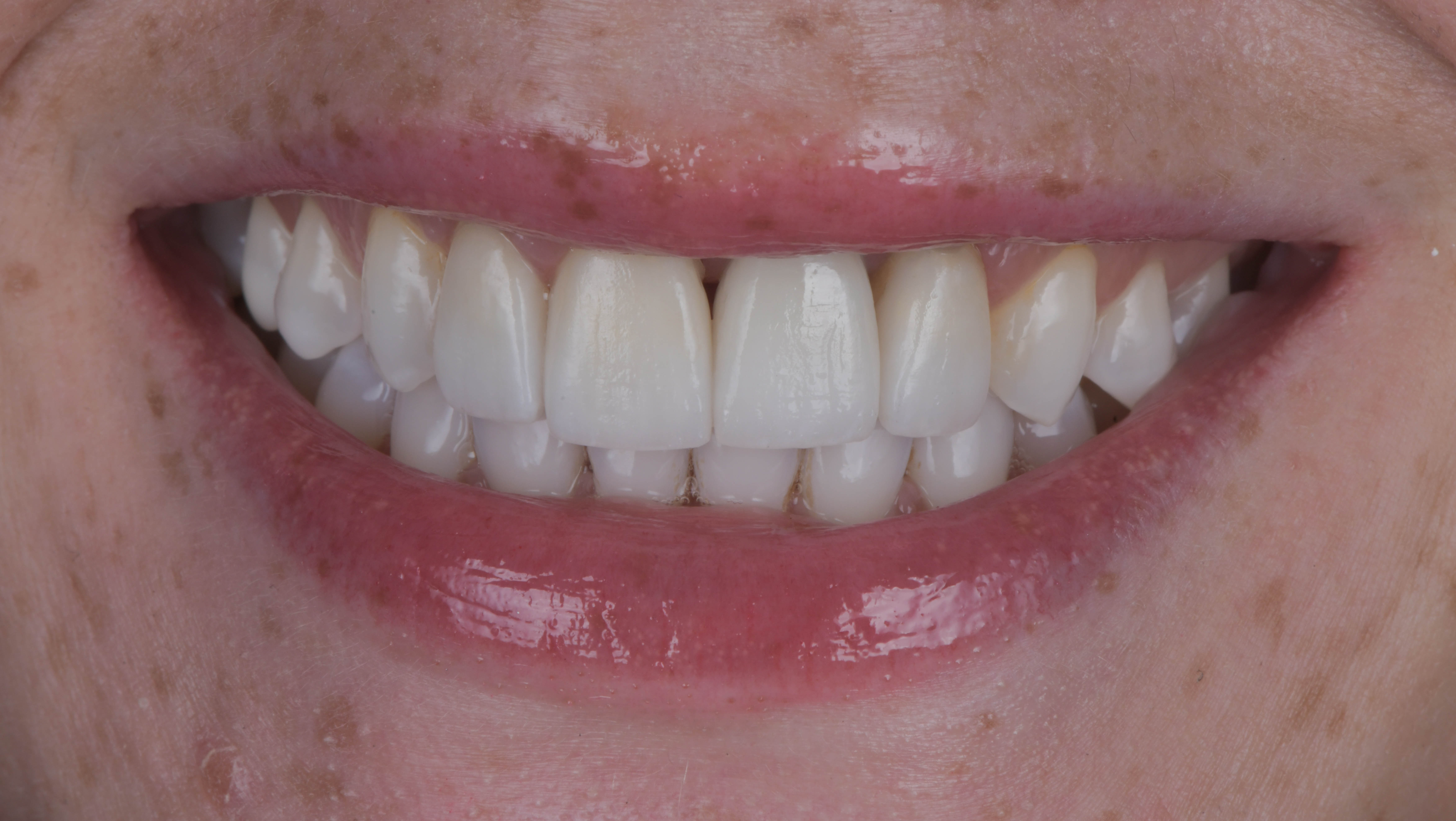 After single dental implant, gum graft and bone graft, Marylebone Smile Clinic