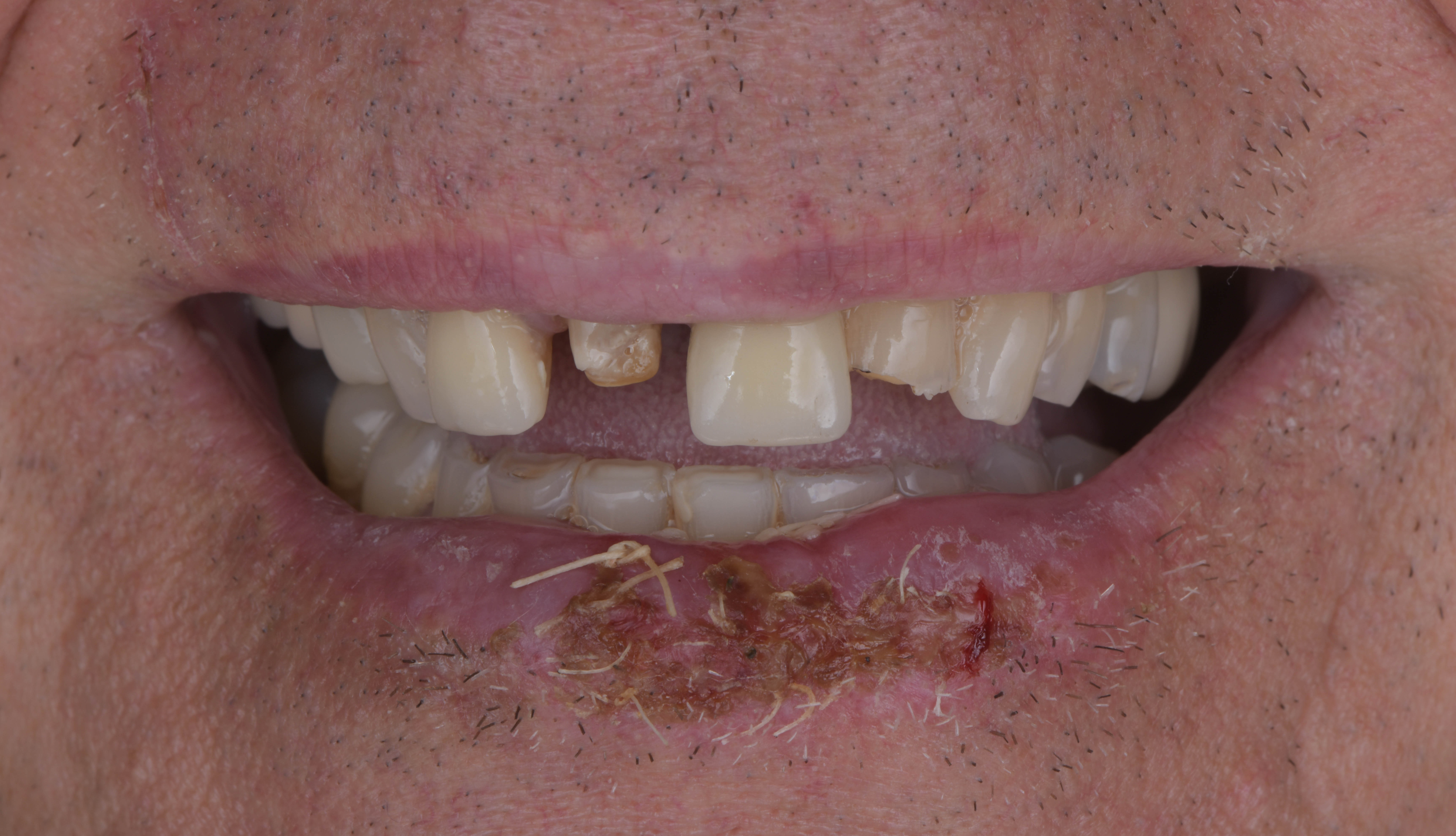 Before single dental implant, trauma case, Marylebone Smile Clinic