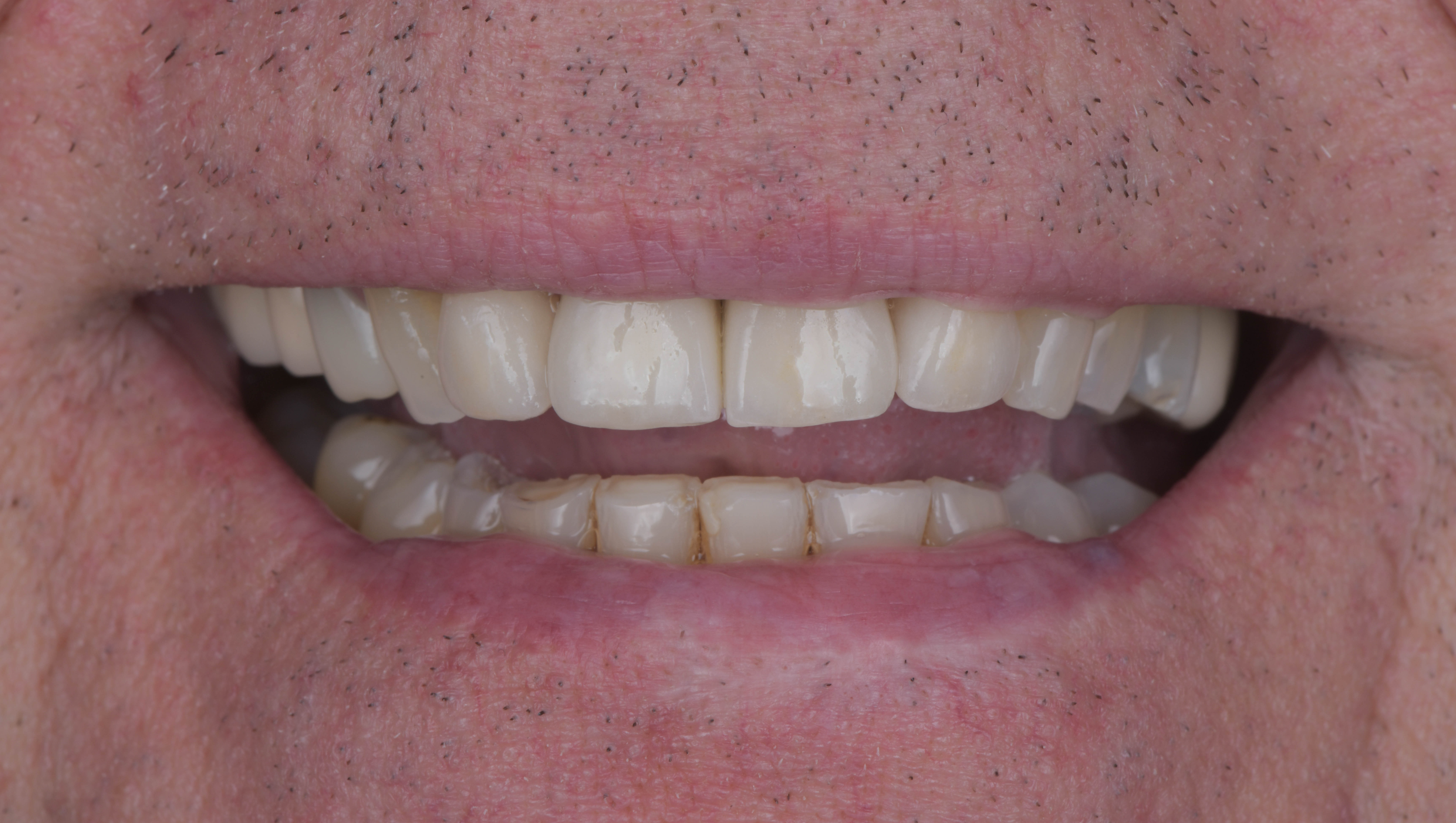 After single dental implant and ceramics, Marylebone Smile Clinic